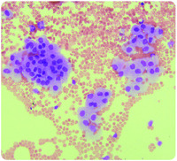 Ependymal cells in cerebrospinal fluid: a traumatic occurrence