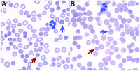 High-density genomic analysis reveals basis of spherocytosis in myelodysplastic syndrome