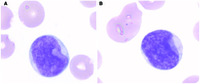 “Cup-like” blasts in acute myeloid leukemia with FLT3 and NPM1 mutations