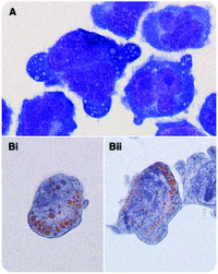 Orange-colored Russell bodies by Papanicolaou stain