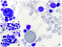 Extreme dyserythropoiesis in the setting of acute erythroid leukemia