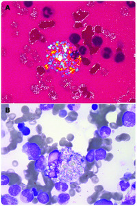 Cystine crystals in bone marrow aspirate