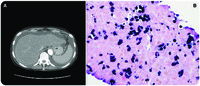 An unusual cause of ascites
