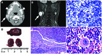 Nodal extramedullary hematopoiesis and facial bone change in thalassemia