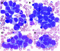 hepatosplenic-t-cell-lymphoma-mimicking-bone-marrow-metastasis