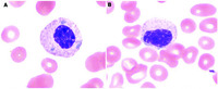 Pseudo–Pelger-Huët anomaly in a patient on tacrolimus