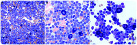 Lymphoplasmacytic lymphoma with prominent mast cell infiltrates