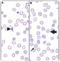 Diagnosing Plasmodium falciparum in a teenage traveler by peripheral blood smear