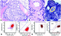 Systemic AL amyloidosis associated with Waldenström macroglobulinemia: an unusual presenting complication