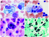 Hemophagocytic Lymphohistiocytosis Secondary To Iatrogenic Disseminated