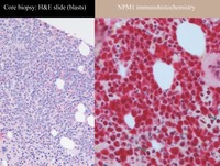 NPM1-mutated IHC staining pattern