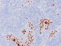 Extracavitary PEL-HHV8 IHC