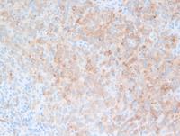 CD10-primary-bone-lymphoma