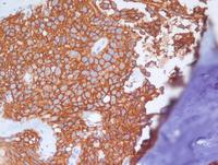 CD20-Primary-bone-lymphoma