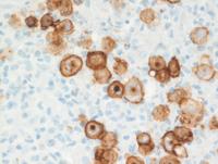 BCLU between DLBCL and CHL