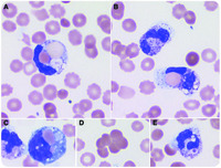 Florid erythrophagocytosis by neutrophils in peripheral blood