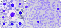 B cells mimicking blasts after an allogeneic stem cell transplantation