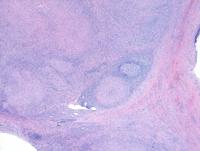 Cat Scratch lymphadenitis