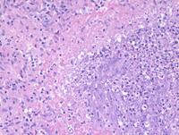 Necrotizing-granulomatous-lymphadenitis