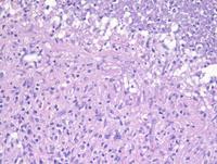 Necrotizing granulomatous lymphadenitis