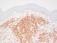 Cutaneous extranodal Marginal zone lymphoma