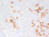 CD30-IHC-CMZL