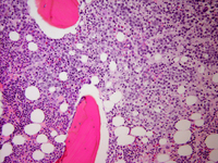 ALK-positive anaplastic large cell lymphoma BM involvement