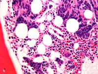 Alveolar rhabdomyosarcoma BMBx IP interface with hematopoiesis