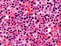 Congenital Dyserythropoietic Anemia (CDA) type II Biopsy