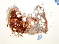 Ewing sarcoma CD99 immunostain