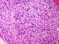 Classical Hodgkin lymphoma involving bone marrow