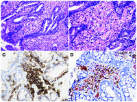 Mott cell (Russell body) Barrett's esophagitis