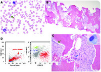 Myelofibrosis secondary to renal osteodystrophy