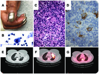 Hodgkin lymphoma mimicking lung abscess