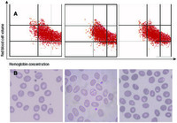 Incidental finding of 3 Southeast Asian ovalocytosis cases by attentive examination of blood smears