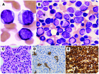 Plasma cell neoplasm with plasmablastic morphology mimicking acute leukemia