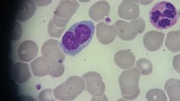 Persistent Polyclonal B-cell lymphocytosis (PPBL)