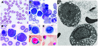 Morphologic features of normoblasts in a case of myopathy, lactic acidosis, and sideroblastic anemia