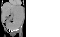 Massive Splenomegaly Radiology