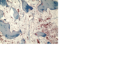 Trichrome Stain in Myelofibrosis