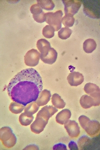 Large Granular Lymphocyte