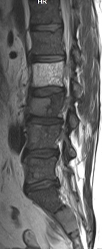 A man with low back pain and anemia 2