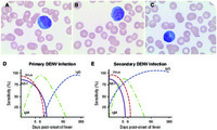 Plasmacytoid lymphocytes: a clue to dengue diagnosis