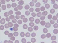 Plasmodium Falciparum