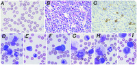 Trilineage dyspoiesis caused by transcobalamin II deficiency