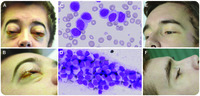 Acute monoblastic leukemia presenting with striking periorbital and periauricular infiltration