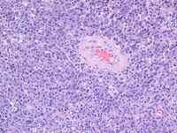 Primary CNS diffuse large B-cell lymphoma