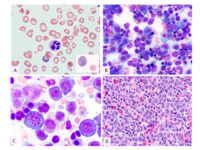 Megaloblastic anemia caused by severe B12 deficiency in a breastfed infant.