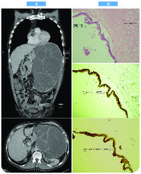 Cystic splenomegaly: ectopic adenocarcinoma of unknown primary