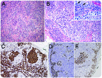 An intrasinusoidal extracavitary variant of primary effusion lymphoma